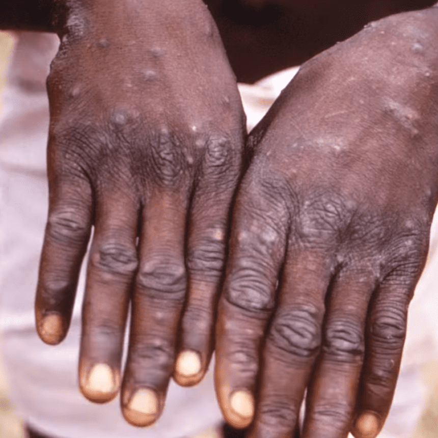 SZO Globalna vanredna situacija zbog širenja virusa majmunskih boginja